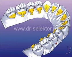 Incognito: Проектирование брекетов с помощью 3D-модели