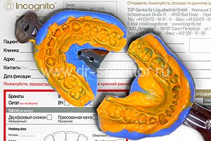 Incognito: Высокоточные силиконовые слепки челюстей пациента