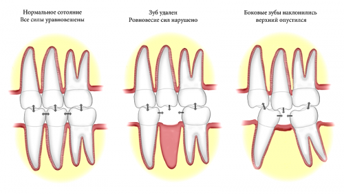 Деформация прикуса после удаления