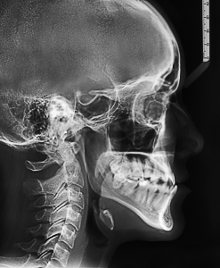 Телерентгенограмма (ТРГ) в боковой проекции