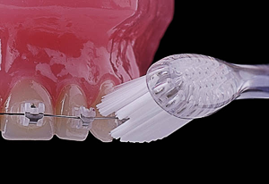 Чистка зубов ортодонтичекой щеткой