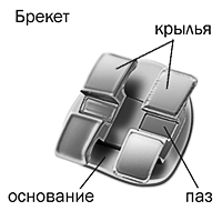 Внешний вид брекета